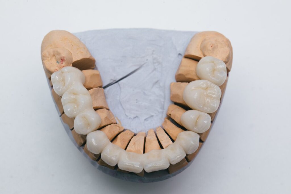Dental Bridges