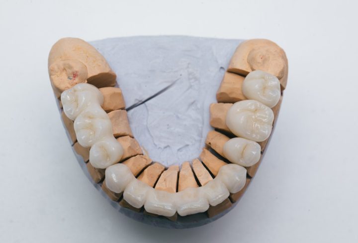 Dental Bridges